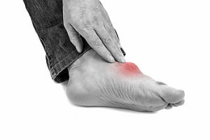 Excess Uric Acid May Cause Gout