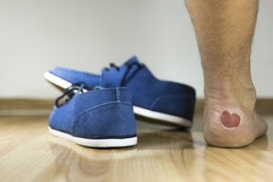What Causes Blisters On The Feet?