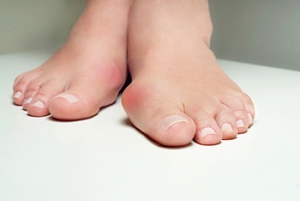 Genetics May Cause Bunions to Form