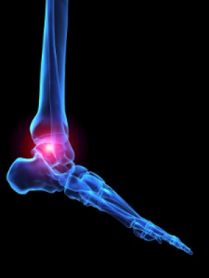 What Is Infectious Arthritis?