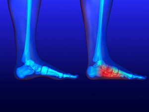 How Are Flat Feet Diagnosed in Children?