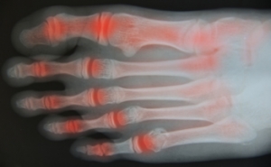 What Are the Early Signs of Foot Arthritis?