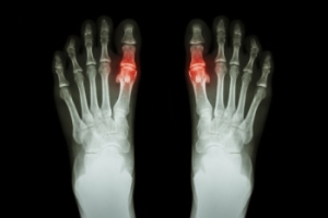 What to Do About Gout