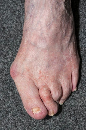 Bunions and Flat Footers