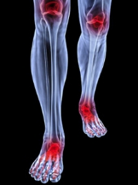 The Development of Rheumatoid Arthritis in the Feet