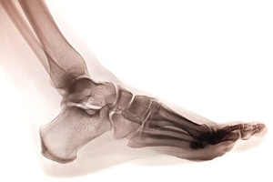 Many People Ignore the Signs of a Stress Fracture