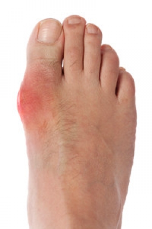 How to Alleviate Symptoms of Gout