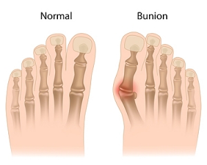 Can Bunions Be Prevented?