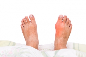 Intense Pain May Accompany Gout