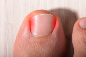 What Are the Symptoms of an Ingrown Toenail?