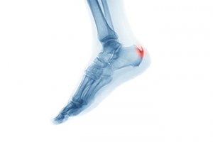 Swelling May Accompany a Heel Spur