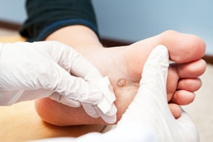Causes and Treatment for Plantar Warts