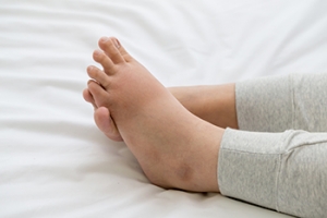 Swollen Feet Affects Most Pregnant Women