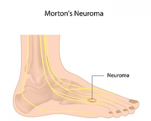Symptoms and Causes of Midfoot Neuromas
