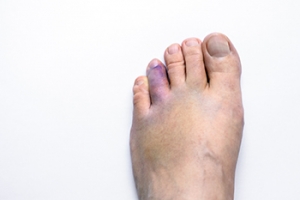 Types and Causes of Broken Toes