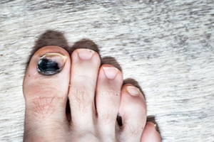 Toenail Issues Common to Runners