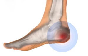 2 Common Causes of Heel Pain