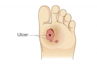 Diabetic Foot Ulcers and the Feet