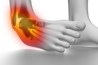 Definition and Grades of Ankle Sprains