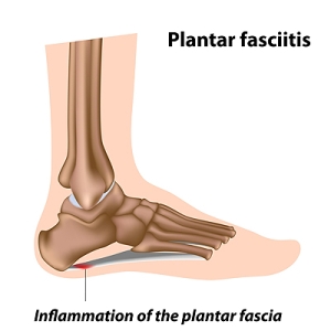 What Does Plantar Fasciitis Feel Like?