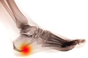 Possible Causes of Heel Spurs