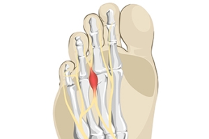 Definition and Incidence of Morton’s Neuroma