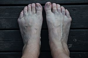 Bunionettes: The Pinky Toe Bunions
