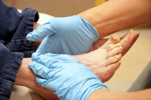 Caring for a Diabetic Foot Ulcer