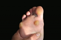 Plantar Warts Are Caused by a Virus